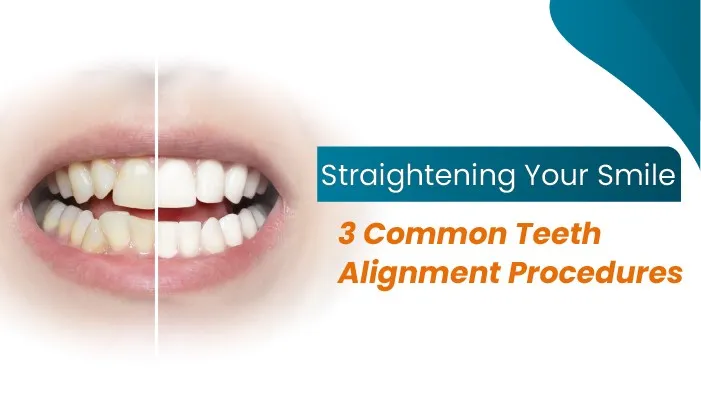 Straightening Your Smile: 3 Common Teeth Alignment Procedures